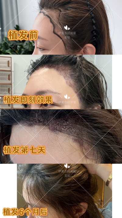 项目图片_植发