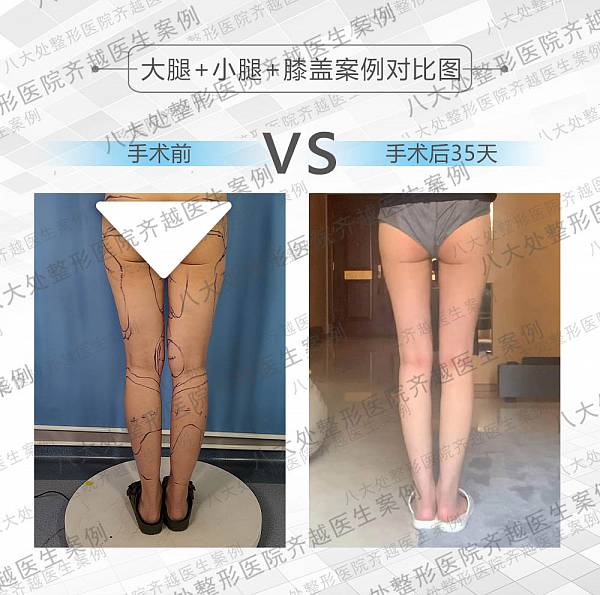 八大处齐越-案例图库_大腿吸脂
