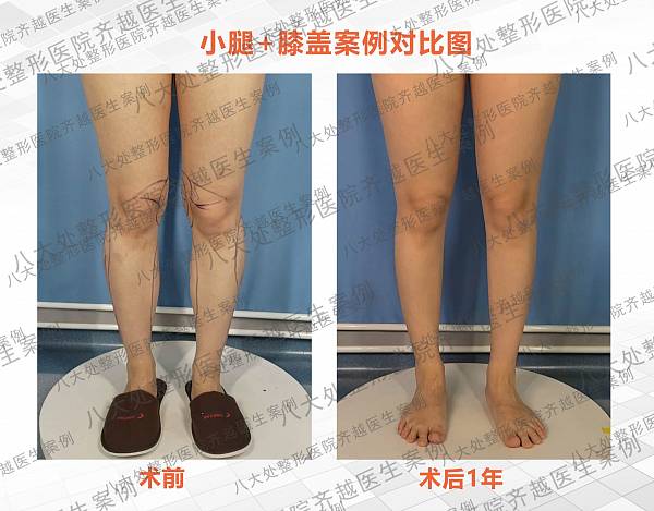 八大处齐越-案例图库_小腿吸脂