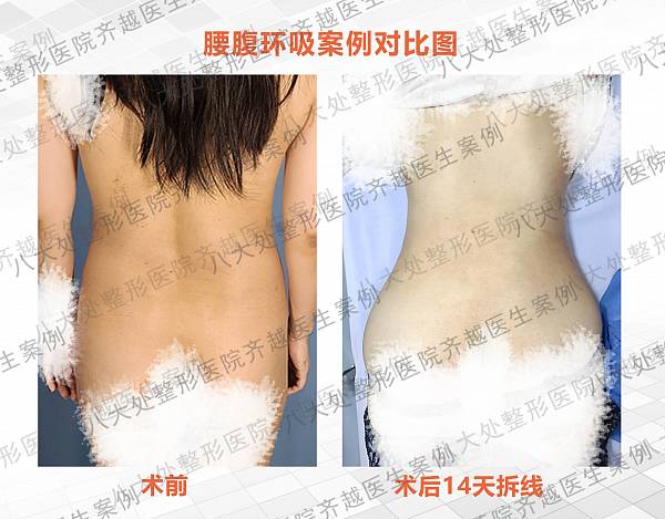 八大处齐越-案例图库_腰腹吸脂